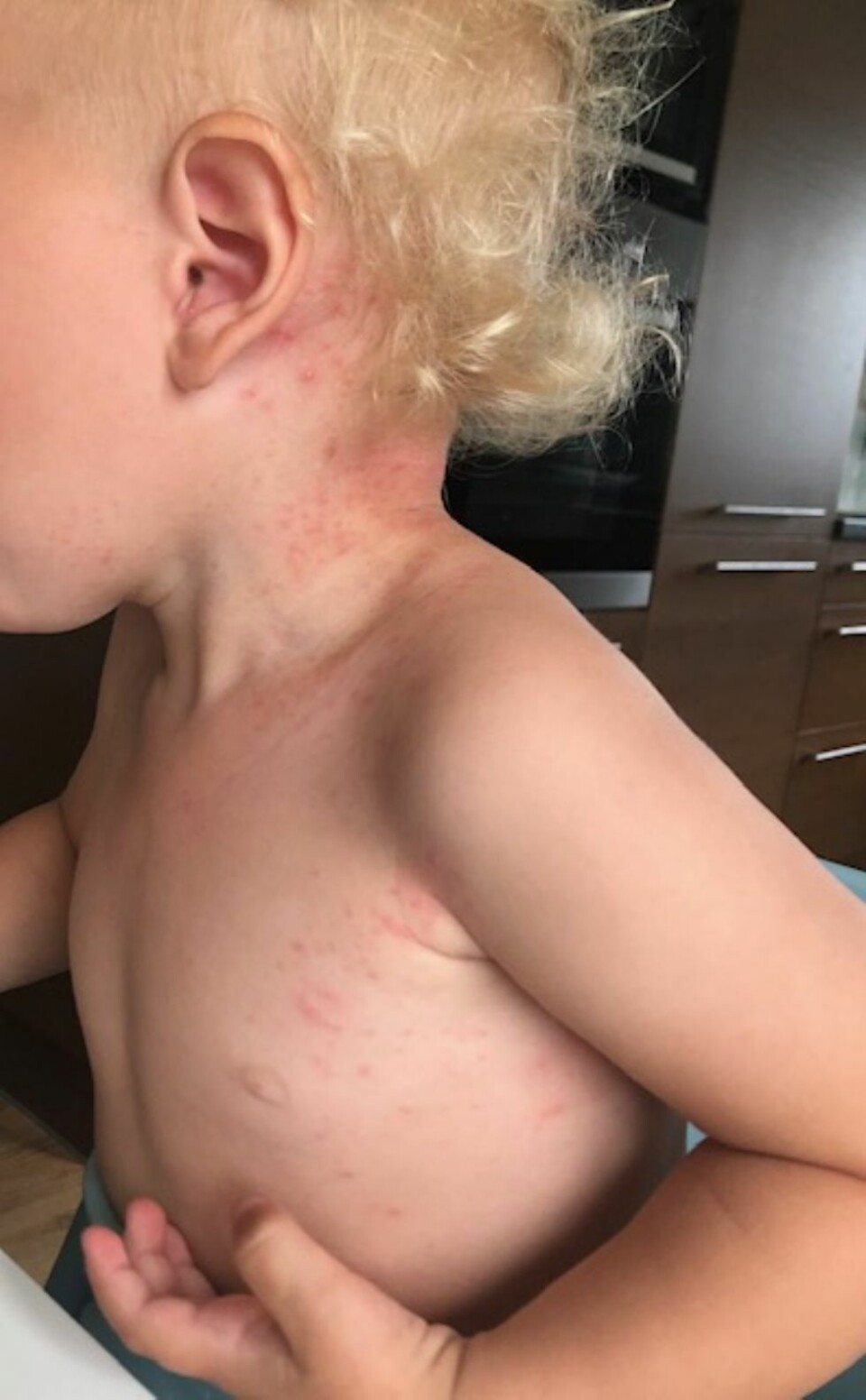 - Flere har fått huden dekket av røde prikker etter bading